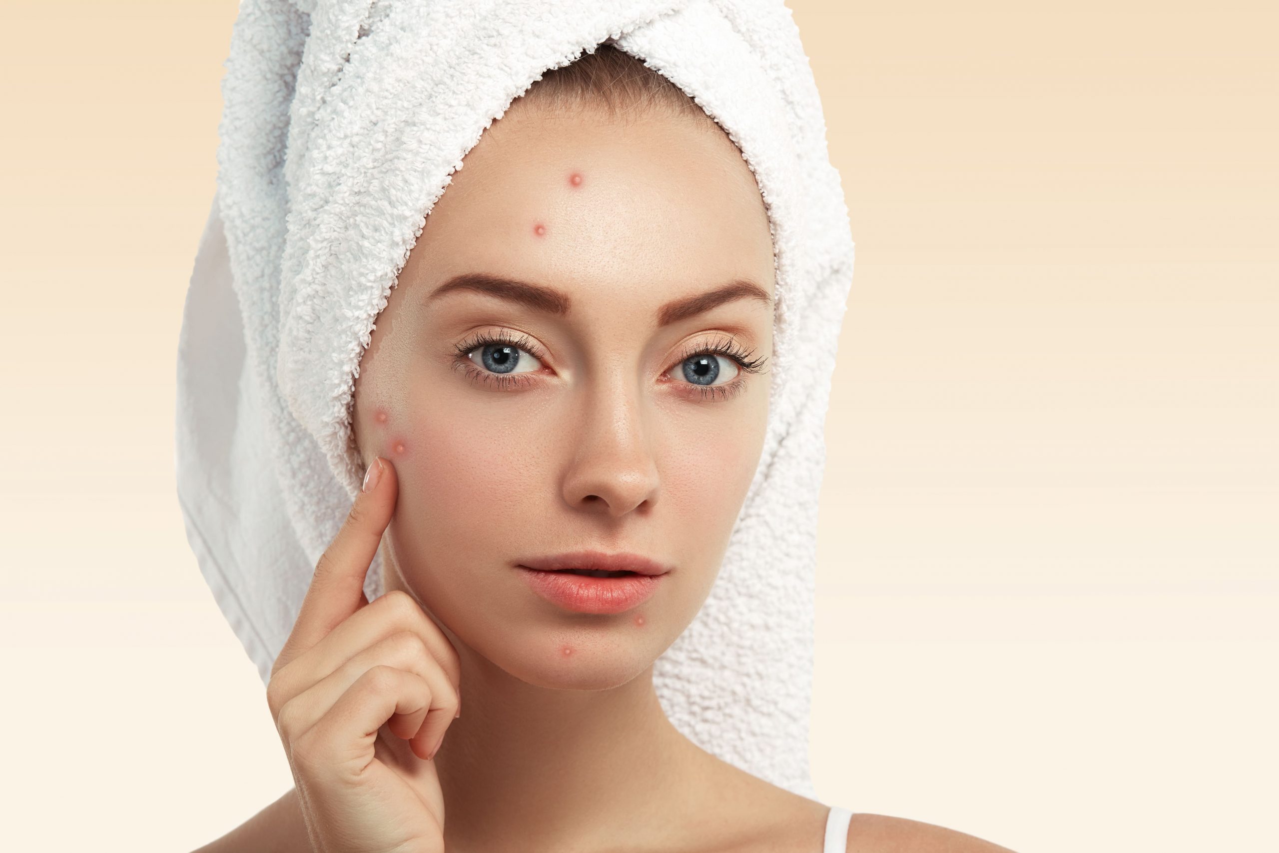 O que é acne?